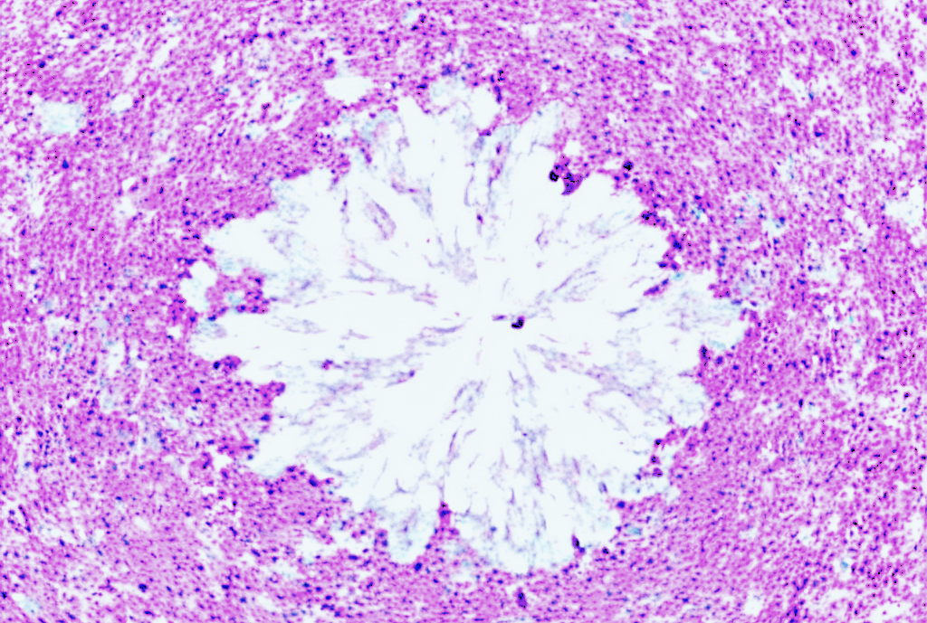 From Early Detection to Prevention: Applications of hTERT-H