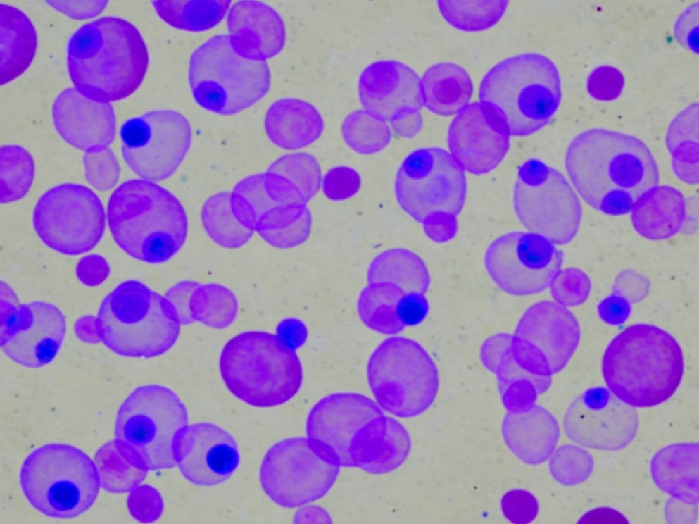 NALM-6 Cell Line: From B-ALL Pathology to Dual-Reporter Mod